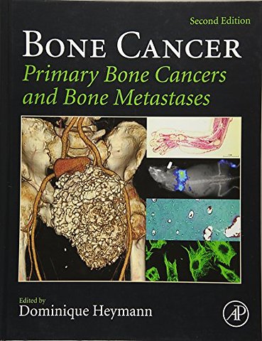 Bone Cancer