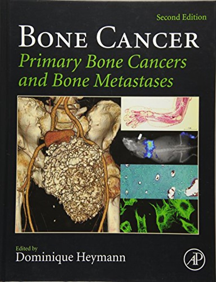 Bone Cancer