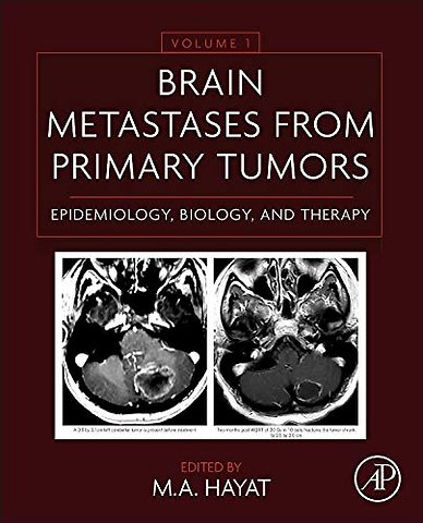 Brain Metastases from Primary Tumors Volume 1