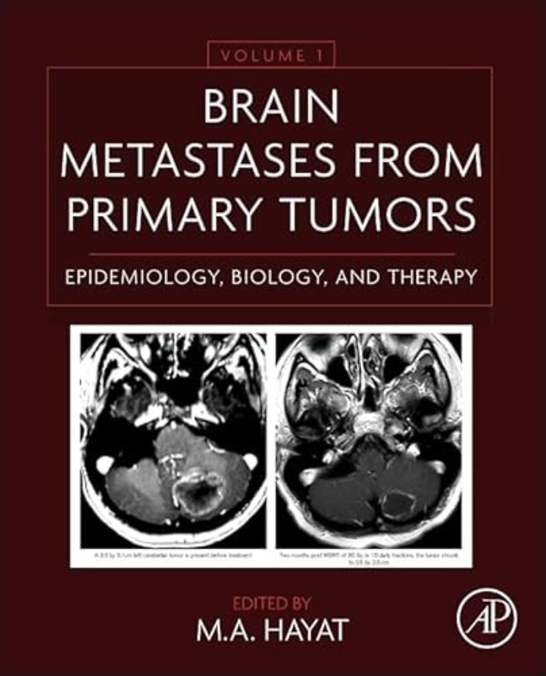 Brain Metastases from Primary Tumors Volume 1