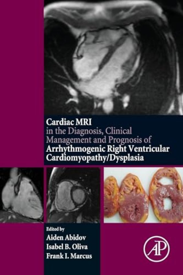 Cardiac MRI in Diagnosis, Clinical Management, and Prognosis of Arrhythmogenic Right Ventricular Cardiomyopathy/Dysplasia