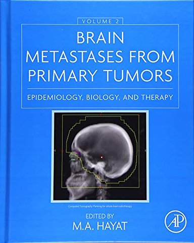Brain Metastases from Primary Tumors, Volume 2