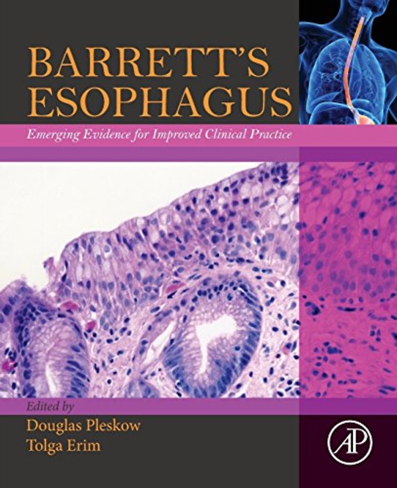 Barrett’s Esophagus
