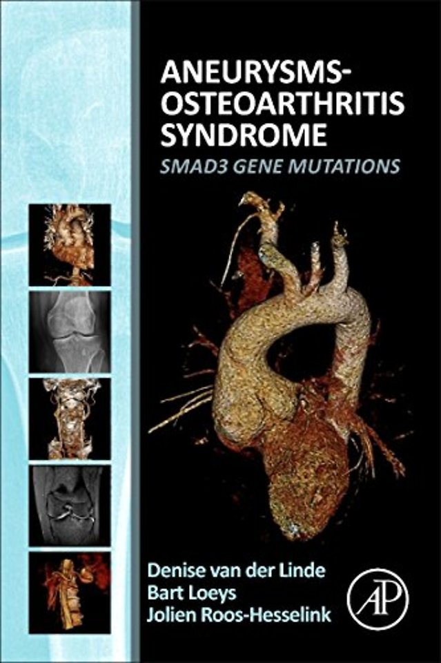 Aneurysms-Osteoarthritis Syndrome