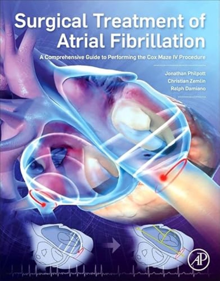 Surgical Treatment of Atrial Fibrillation