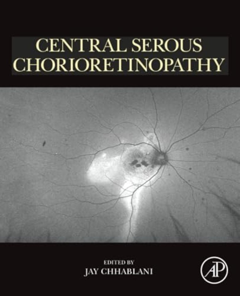 Central Serous Chorioretinopathy