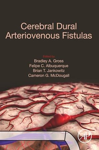 Cerebral Dural Arteriovenous Fistulas