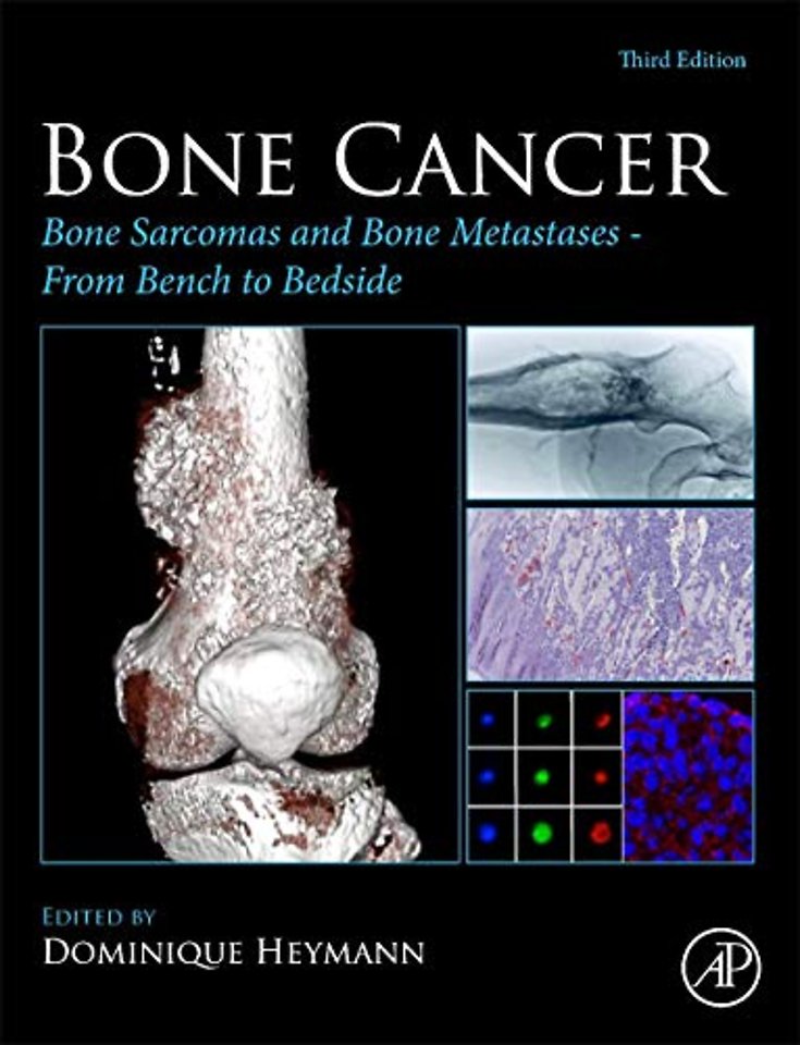 Bone Cancer
