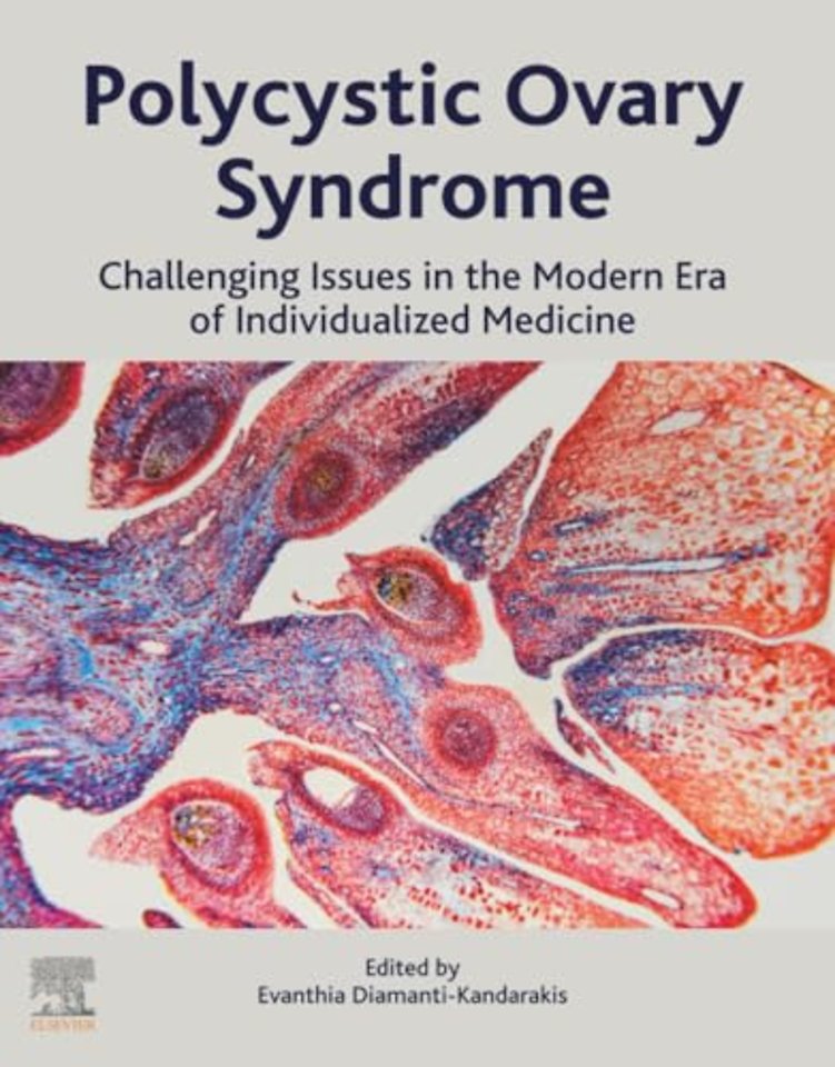 Polycystic Ovary Syndrome