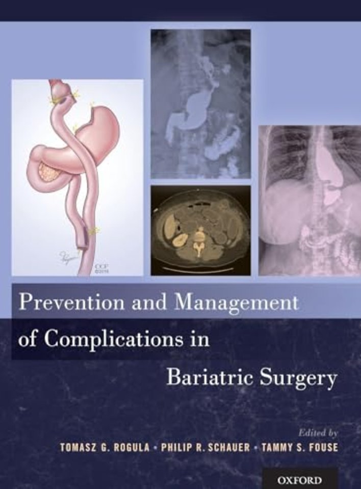 Prevention and Management of Complications in Bariatric Surgery