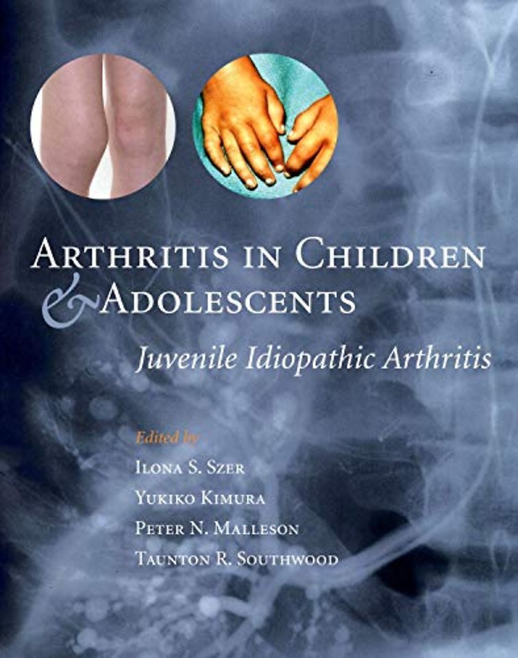 Arthritis in Children and Adolescents