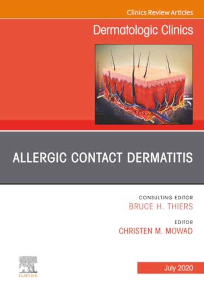 Allergic Contact Dermatitis, An Issue of Dermatologic Clinics