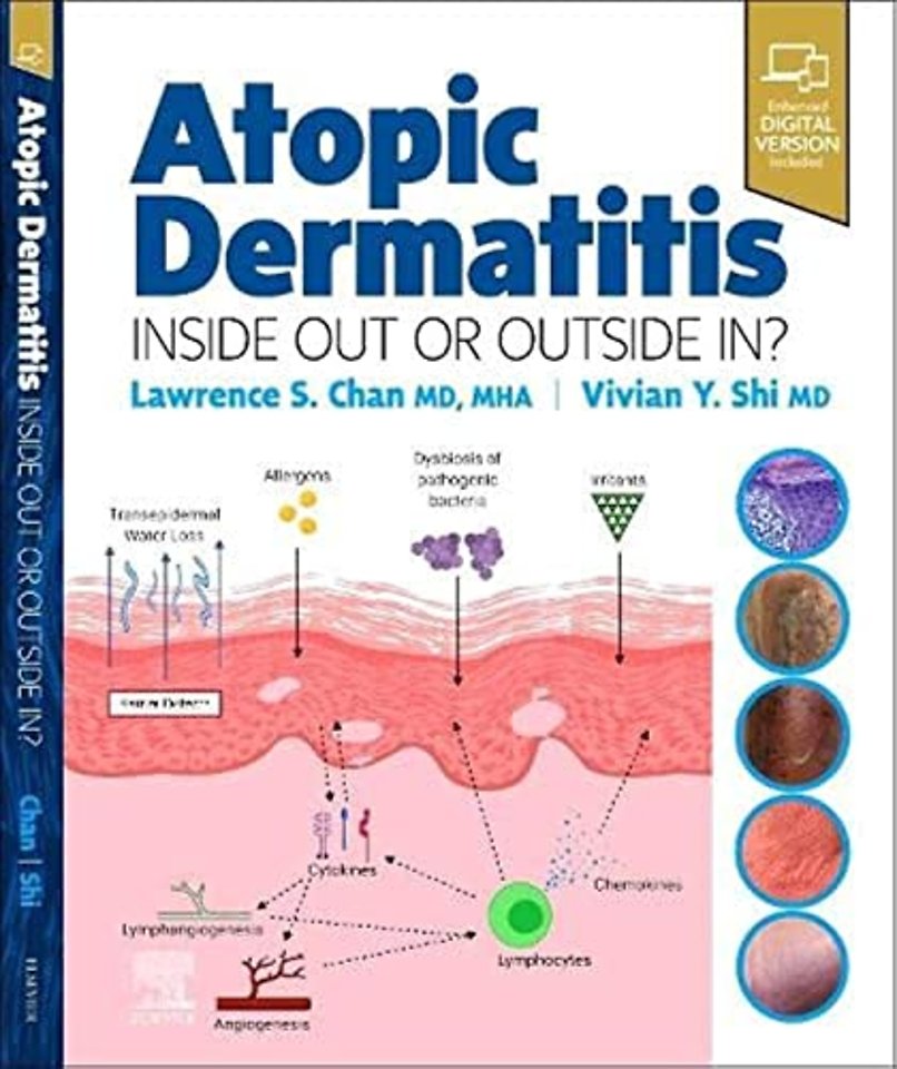 Atopic Dermatitis: Inside Out or Outside In