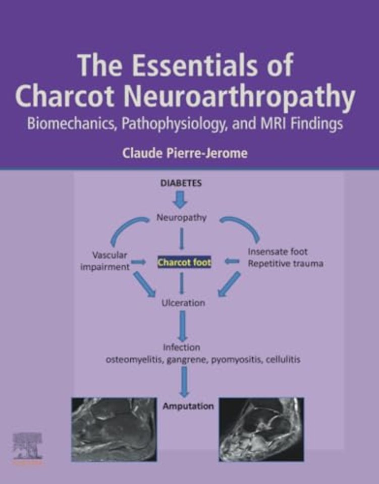 The Essentials of Charcot Neuroarthropathy