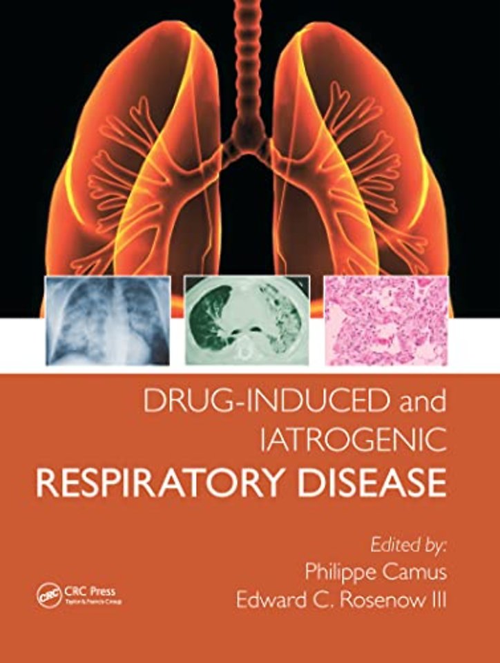 Drug-induced and Iatrogenic Respiratory Disease