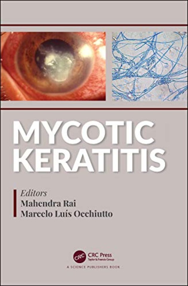 Mycotic Keratitis