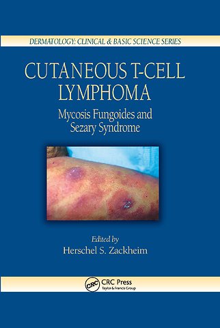 Cutaneous T-Cell Lymphoma