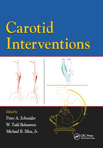 Carotid Interventions