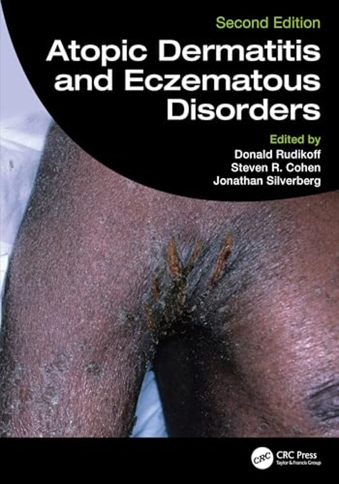 Atopic Dermatitis and Eczematous Disorders