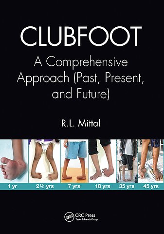 Clubfoot
