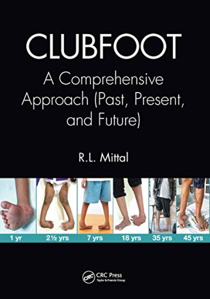 Clubfoot