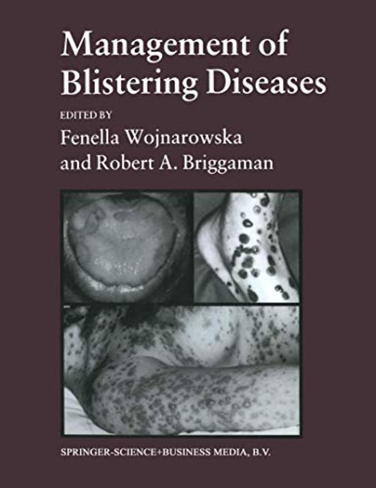 Management of Blistering Diseases