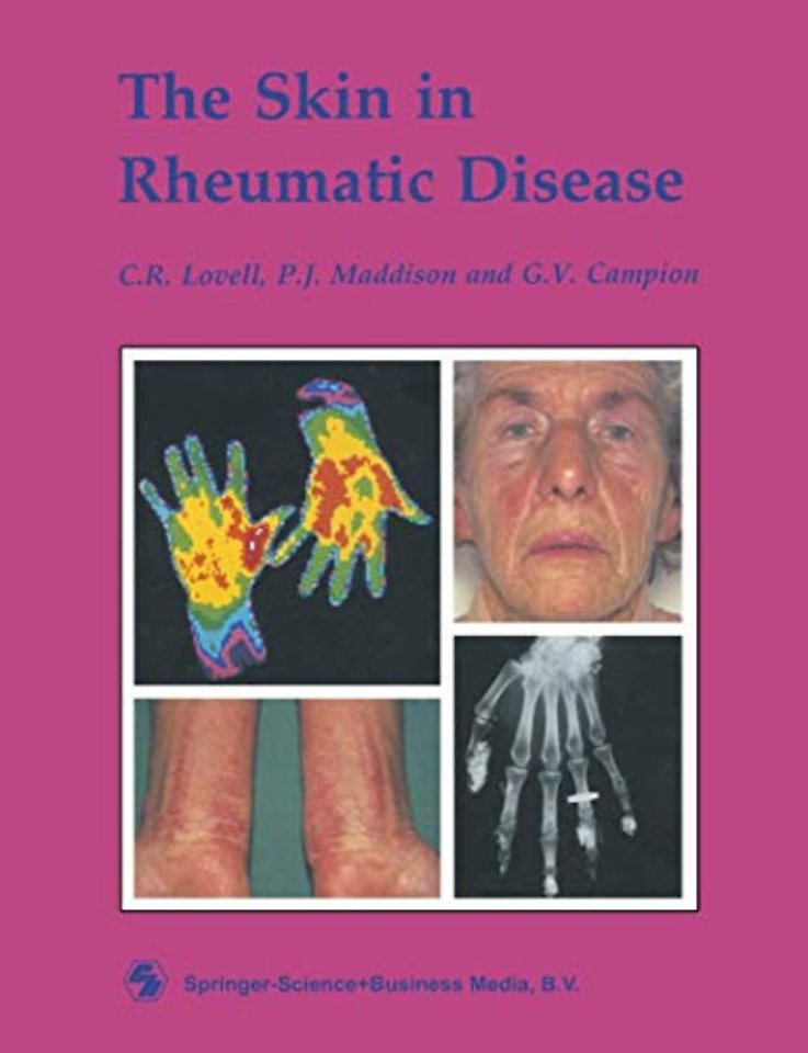 The Skin in Rheumatic Disease