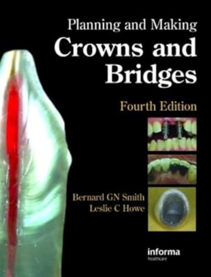 Planning and Making Crowns and Bridges