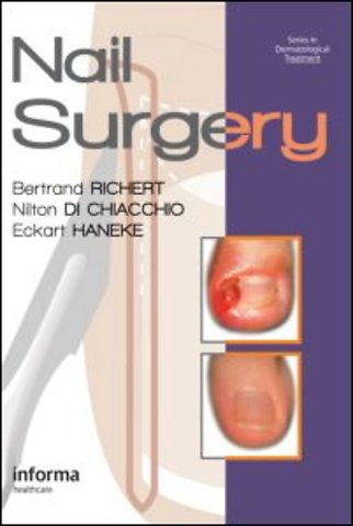 Nail Surgery