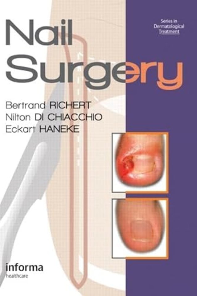 Nail Surgery