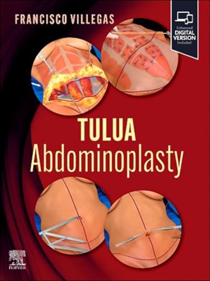 TULUA Abdominoplasty