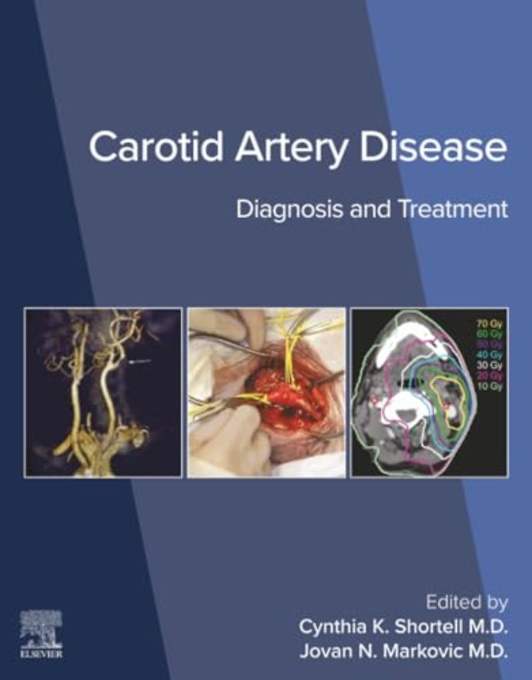 Carotid Artery Disease