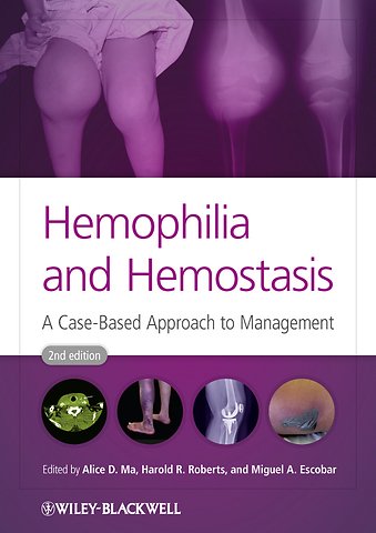 Hemophilia and Hemostasis – A Case–Based Approach to Management 2e