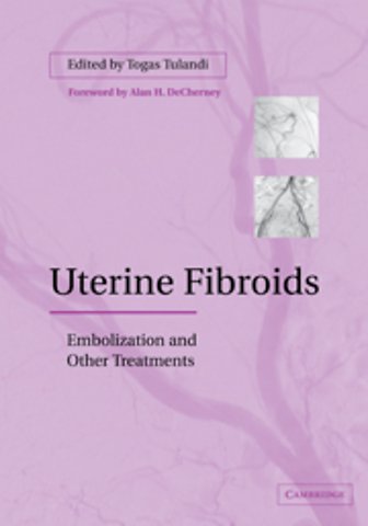 Uterine Fibroids