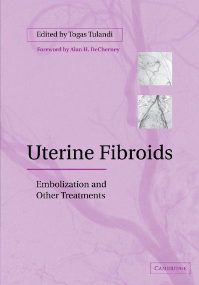 Uterine Fibroids