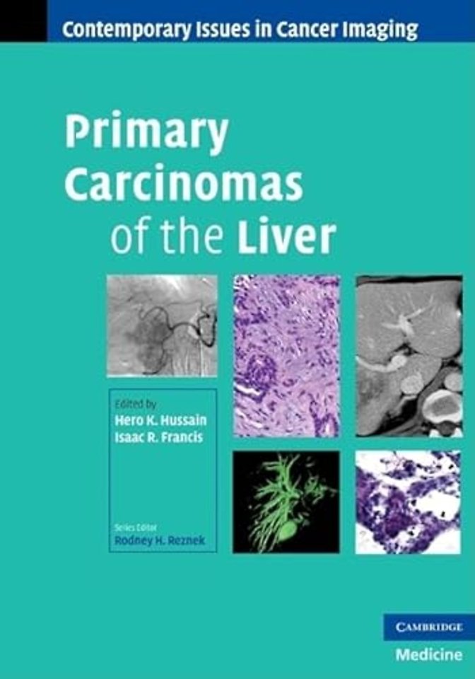 Primary Carcinomas of the Liver