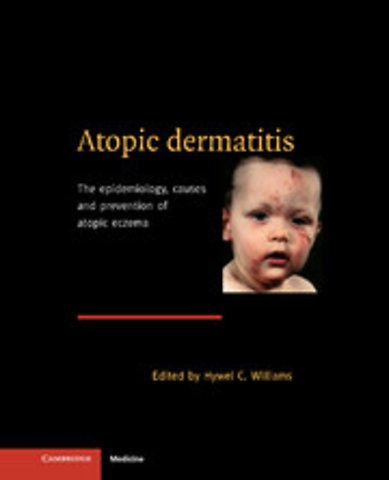 Atopic Dermatitis