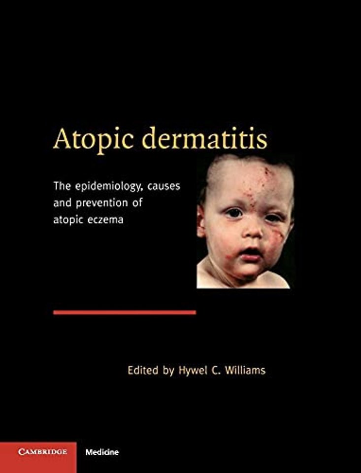 Atopic Dermatitis