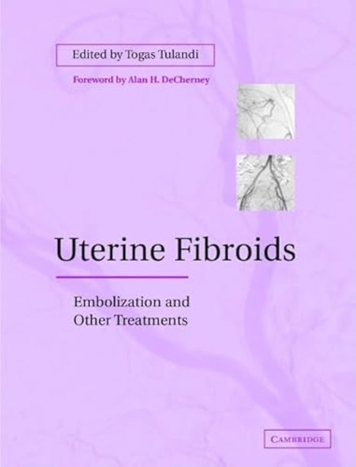 Uterine Fibroids
