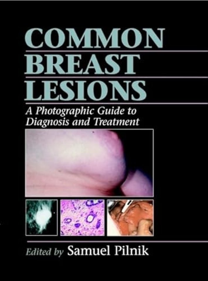Common Breast Lesions