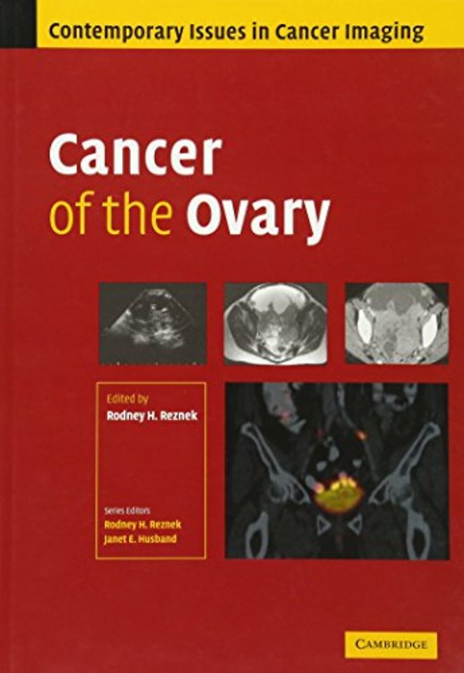 Cancer of the Ovary