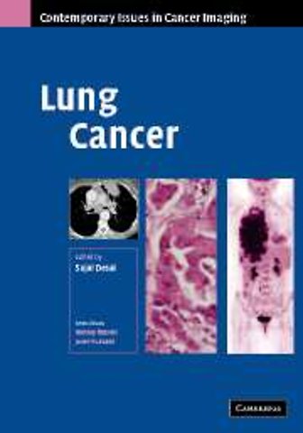 Lung Cancer