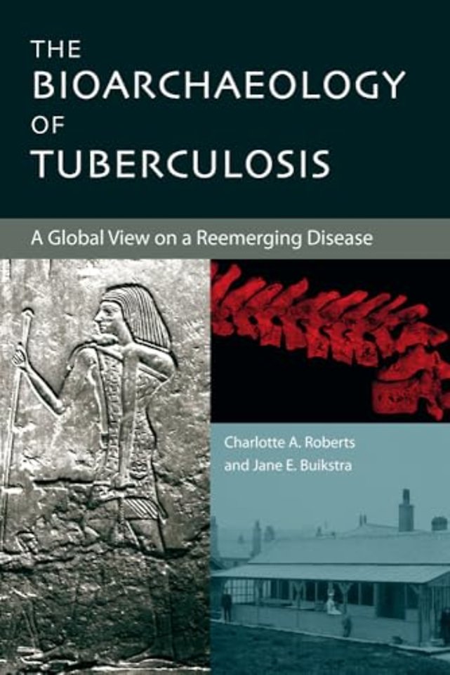 The Bioarchaeology of Tuberculosis – A Global View on a Reemerging Disease