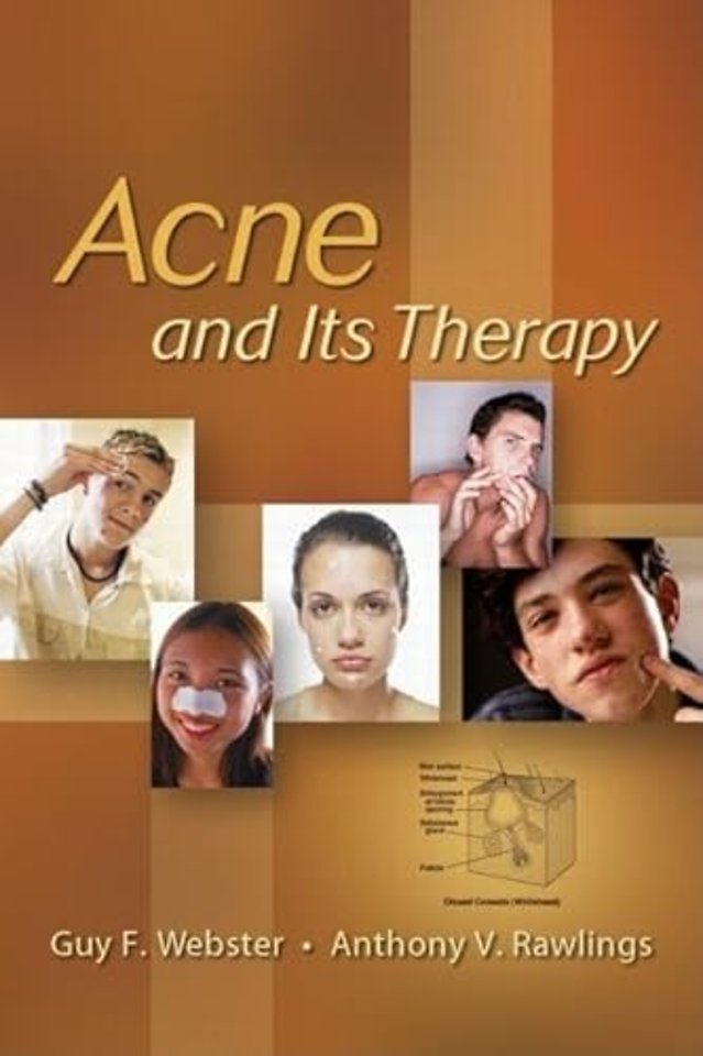 Acne and Its Therapy