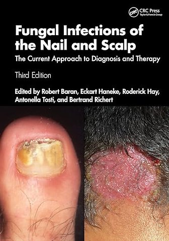 Fungal Infections of the Nail and Scalp