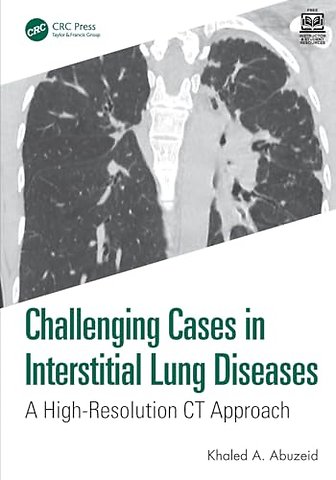 Challenging Cases in Interstitial Lung Diseases