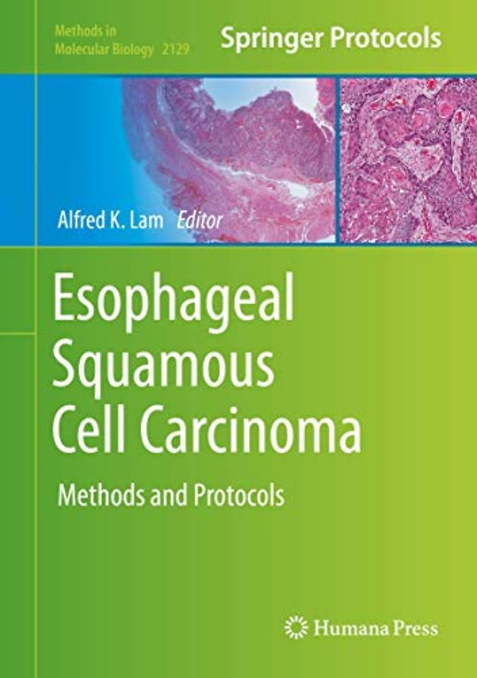 Esophageal Squamous Cell Carcinoma