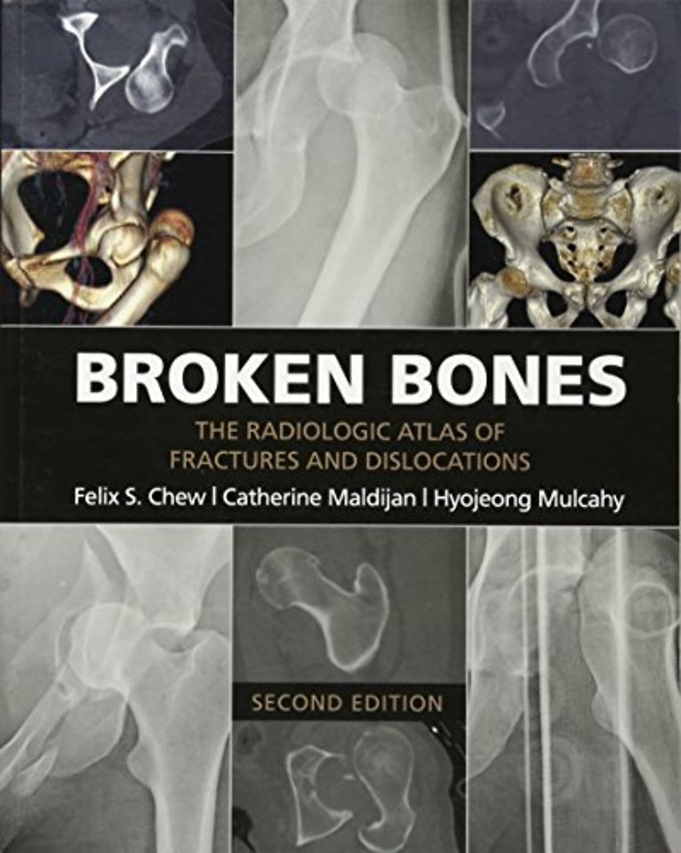 Broken Bones