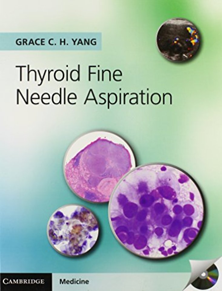 Thyroid Fine Needle Aspiration with CD Extra