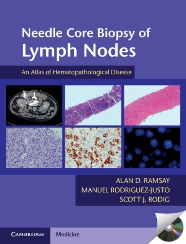 Needle Core Biopsy of Lymph Nodes with DVD-ROM
